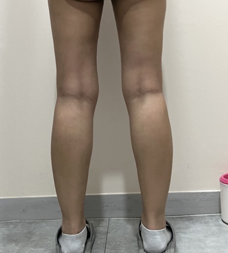 after photo: 복부지방흡입, 아르기닌수액