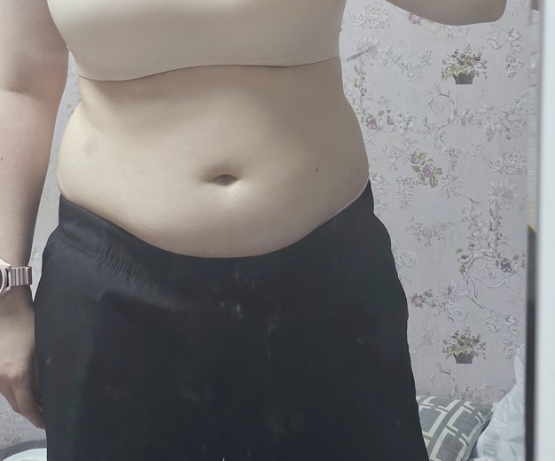 before photo: 러브핸들지방흡입, 복부지방흡입