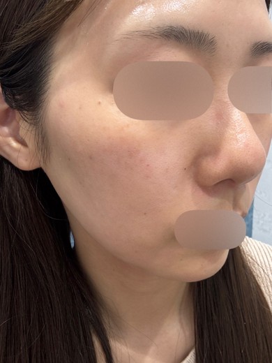 before photo: ルメッカ