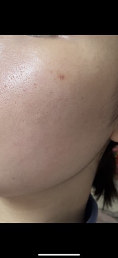 before photo: 리쥬란힐러