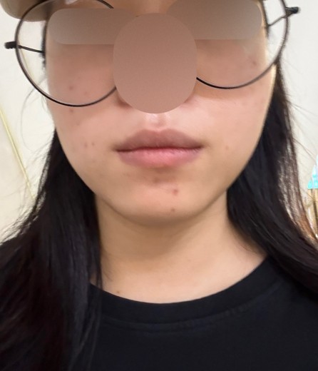 after photo: 여드름압출, 여드름주사