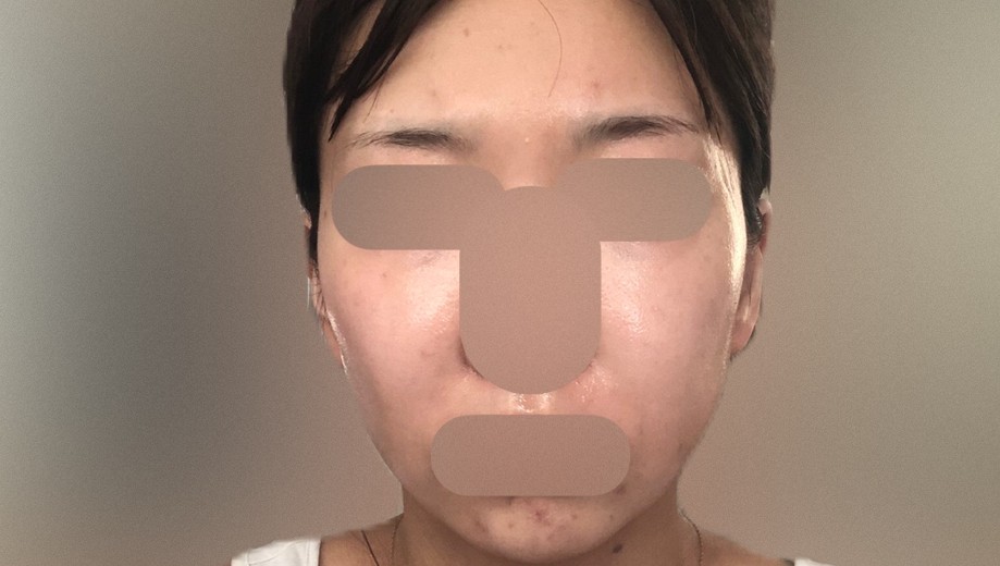 after photo: IPL(光/フォト治療)