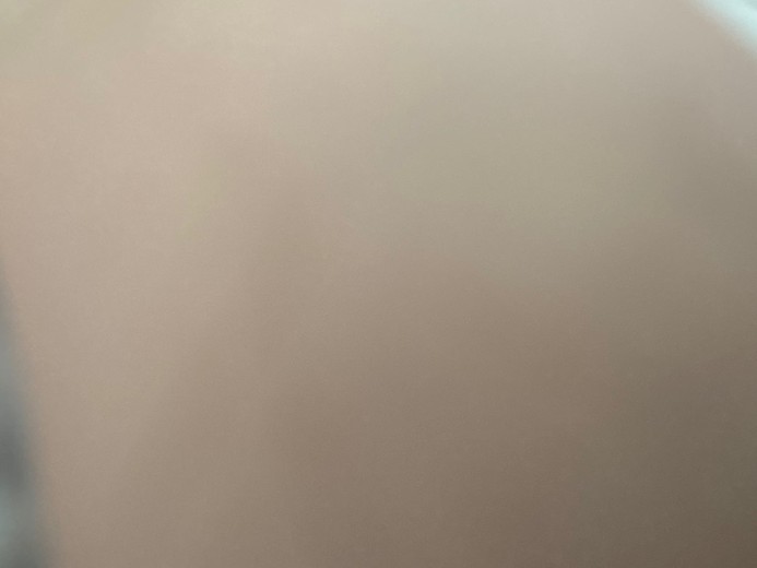 before photo: 脱毛(ワキ)