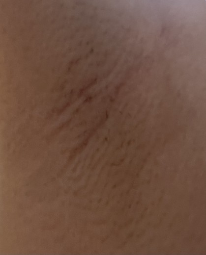 after photo: 겨드랑이제모