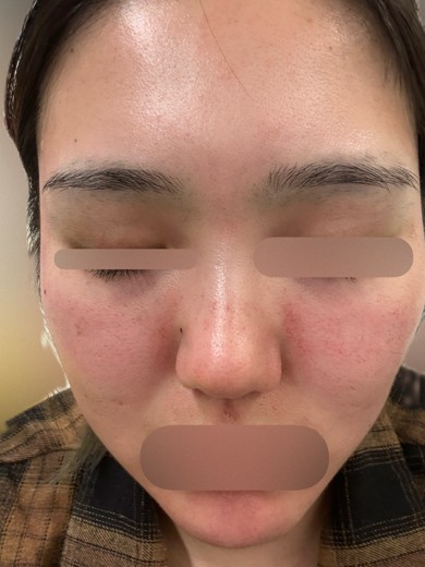 after photo: ダーマペン