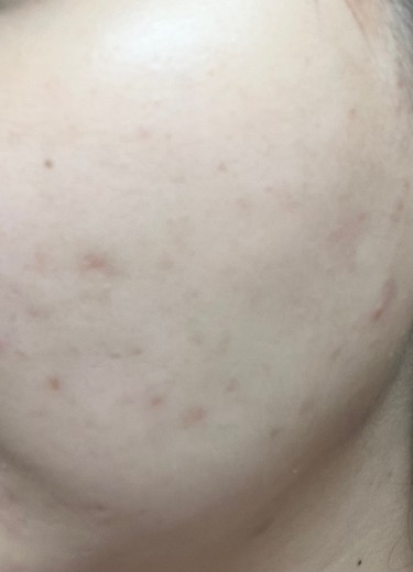 after photo: ダーマペン