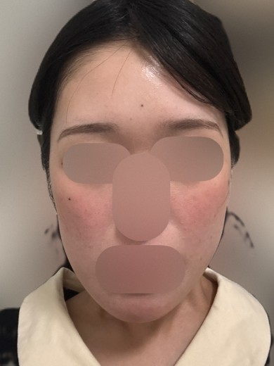 after photo: イオン導入