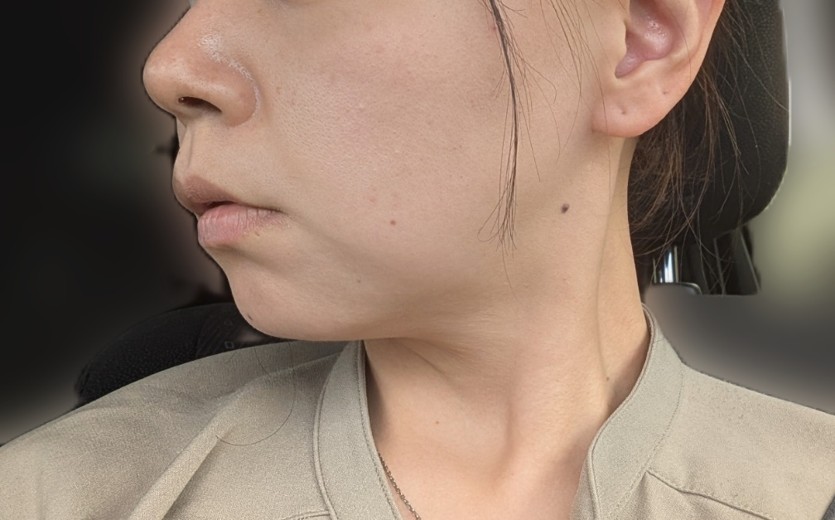 after photo: ソノクイーン(ハイフ)