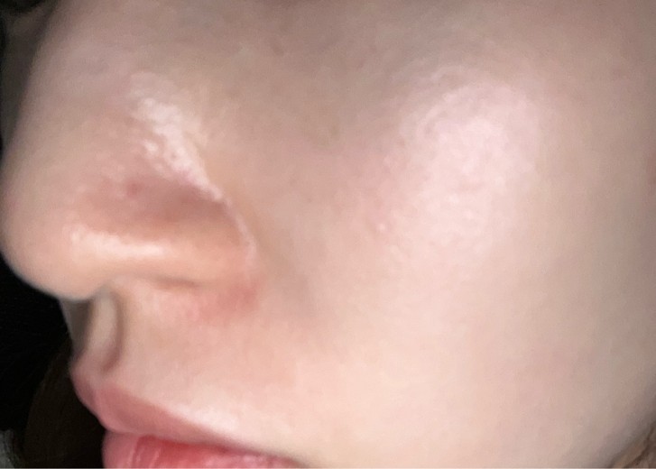 before photo: ダーマペン