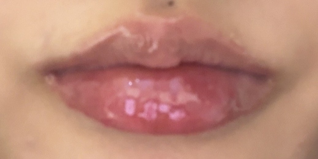 after photo: 입술필러