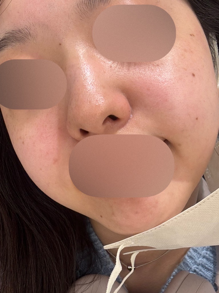 ハイドラフェイシャル｜全顔｜毛穴洗浄 | AELLE CLINIC 表参道