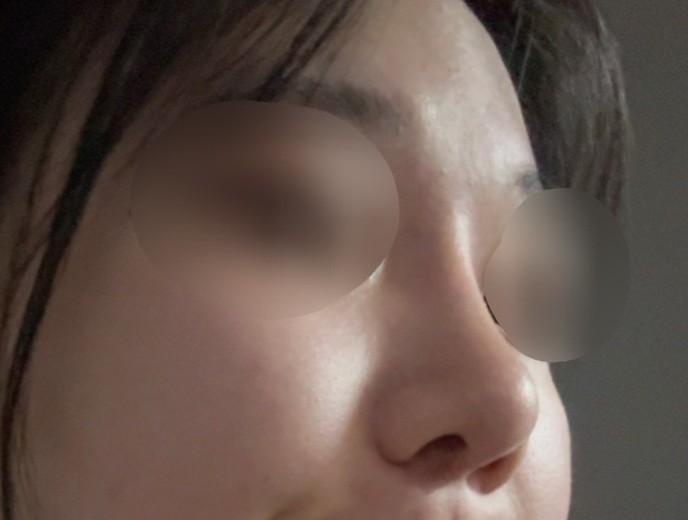 after photo: 비중격만곡증수술, 콧대(자가조직), 코끝(자가연골)