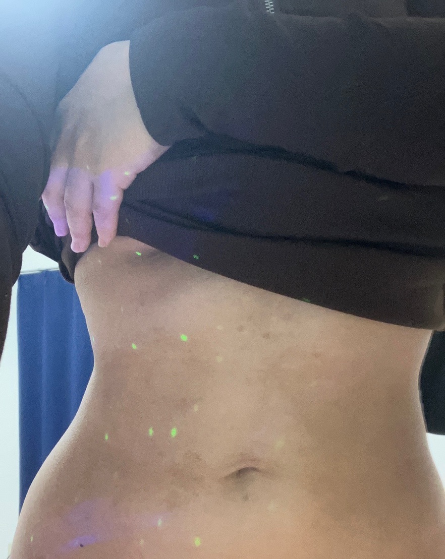 2023年最新 脂肪冷却新品 脂肪冷却 - 八千代醫美集團