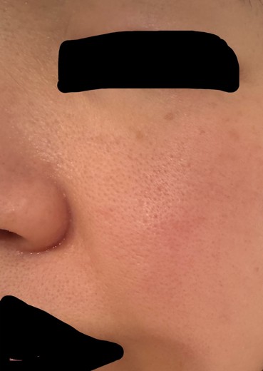 after photo: ピコトーニング, ハイドラフェイシャル, ピコフラクショナル, イオン導入