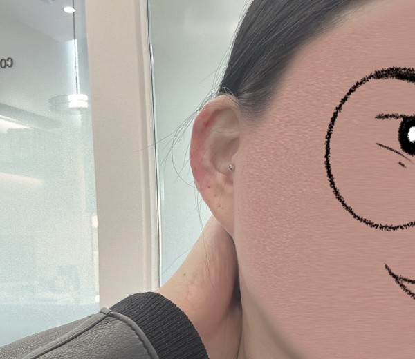 after photo: 귓볼필러