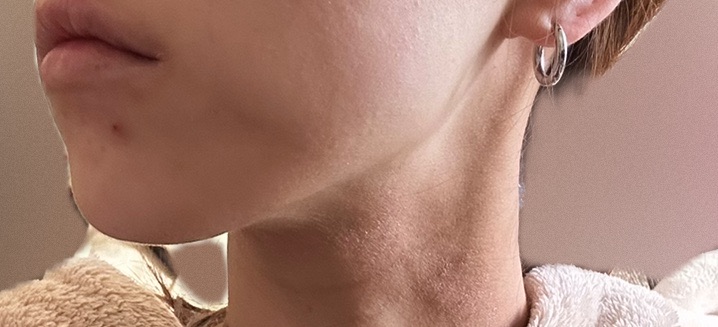 再来OK｜ボツリヌストキシン】平日限定｜ボトックス200単位（韓国製