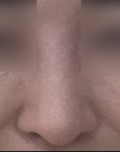 after photo: 콧대(보형물), 코끝(자가연골)