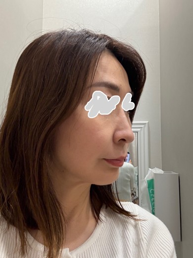 before photo: ボルニューマ