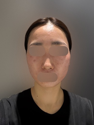 after photo: ハイドラフェイシャル, 診断・検査