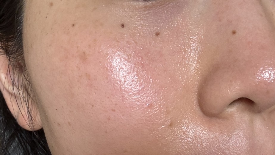 after photo: IPL(光/フォト治療)