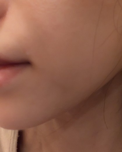after photo: 糸リフト, メーラー/ジョール/バッカルファット除去