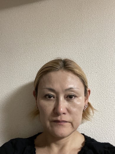 after photo: マッサージピール(コラーゲンピール)