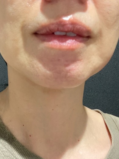 after photo: ダブロ(ハイフ)
