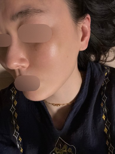 after photo: 스킨보톡스