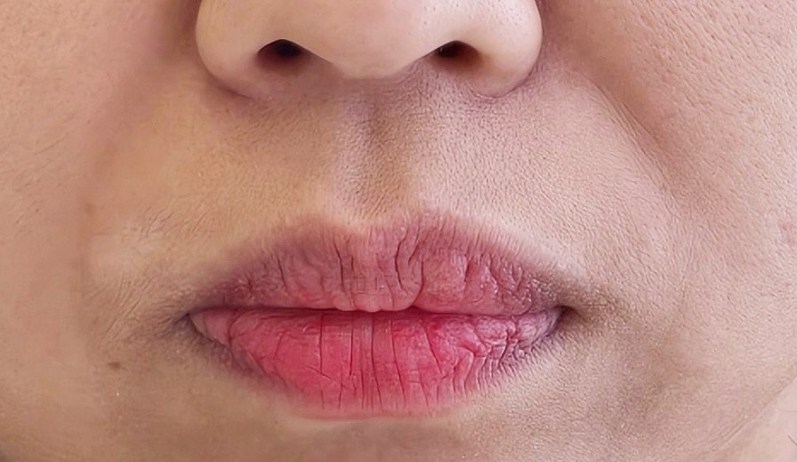 before photo: CO2레이저, PRP피부재생술