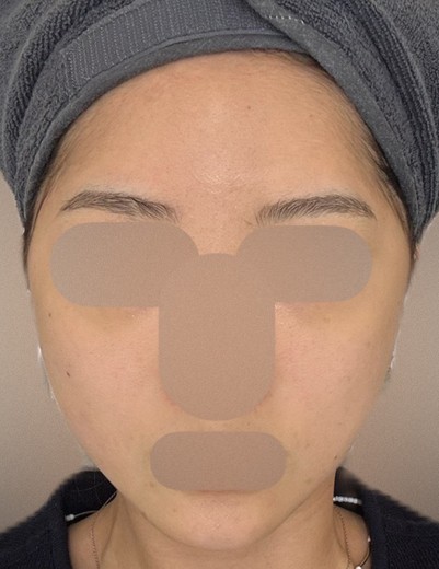 before photo: 온다리프팅