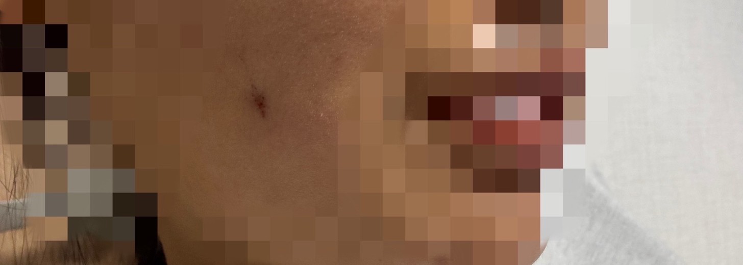 after photo: 보조개성형