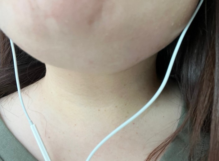 after photo: 脂肪溶解注射(顔)