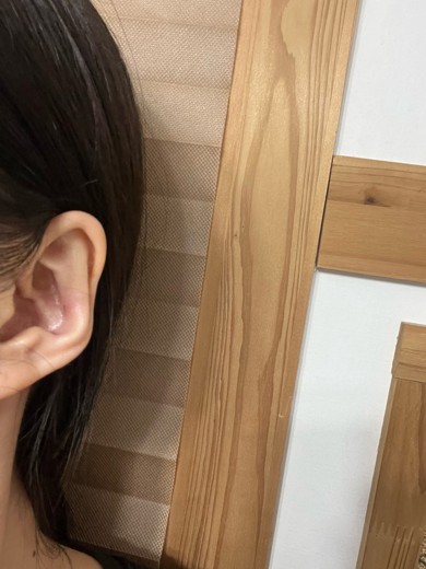 after photo: 캘로이드귀성형