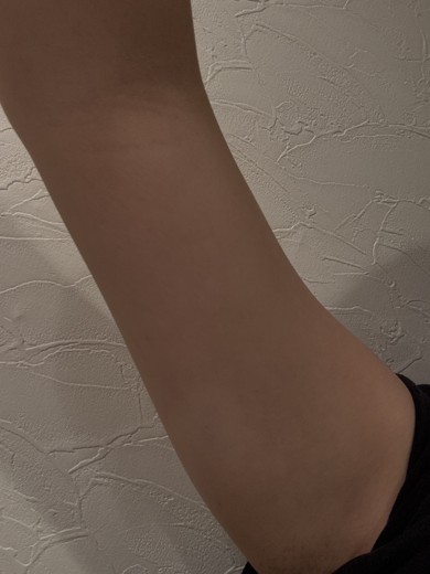 before photo: 脂肪溶解注射(腕)