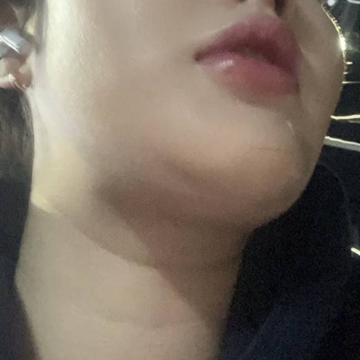 before photo: 이중턱지방흡입, 이중턱근육묶기