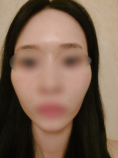 after photo: IPL(光/フォト治療)