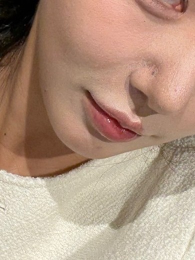 before photo: 실리프팅