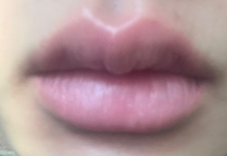 after photo: 입술필러