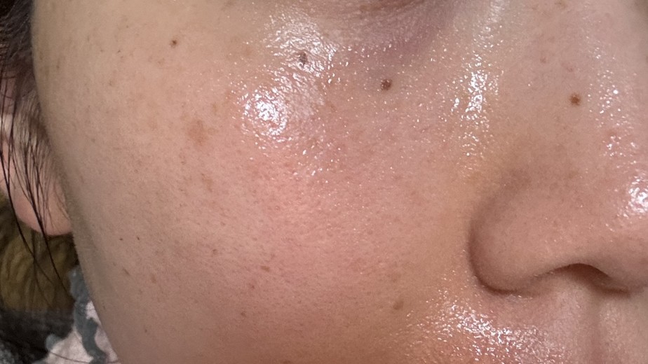 after photo: IPL(光/フォト治療)