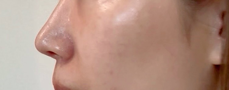 ヒアルロン酸注入（1cc・ニューラミス）｜額・顎・涙袋・唇・貴族