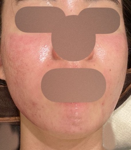 before photo: ダーマペン