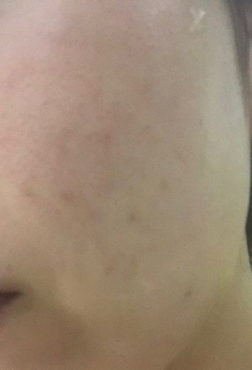 before photo: IPL(光/フォト治療)