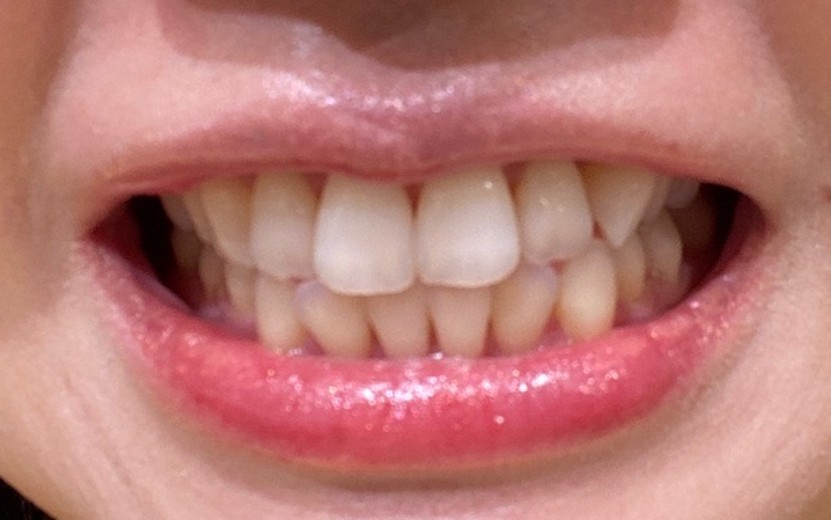 after photo: ホワイトニング