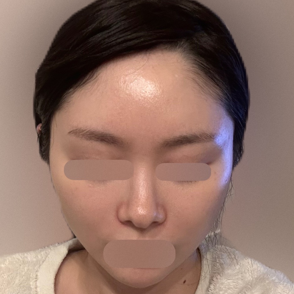 エレクトロポレーション【再来OK】 | ライズワン美容皮膚科クリニック