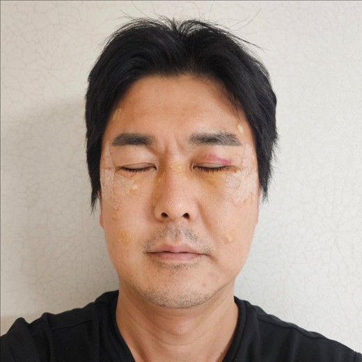 after photo: 눈밑지방재배치