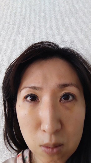 after photo: 脱脂(クマ治療)