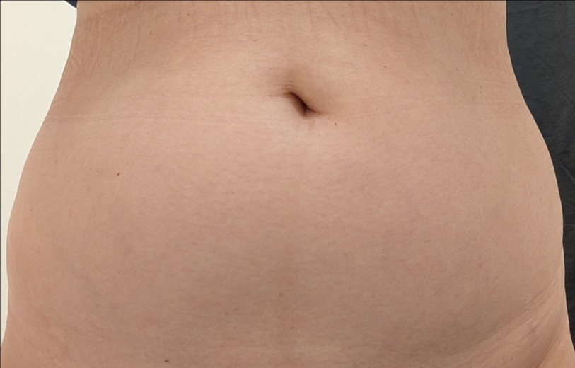 before photo: 脂肪冷却(腕), 脂肪冷却(腹部)