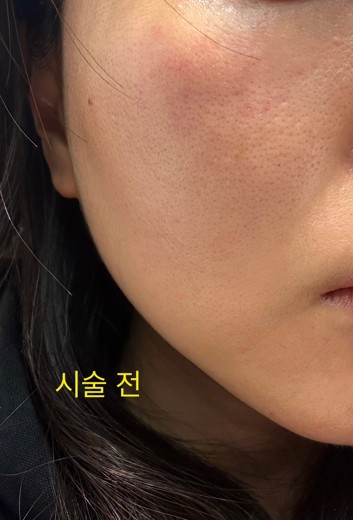 before photo: 쥬베룩