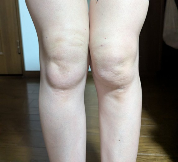 after photo: 脂肪溶解注射(太もも)