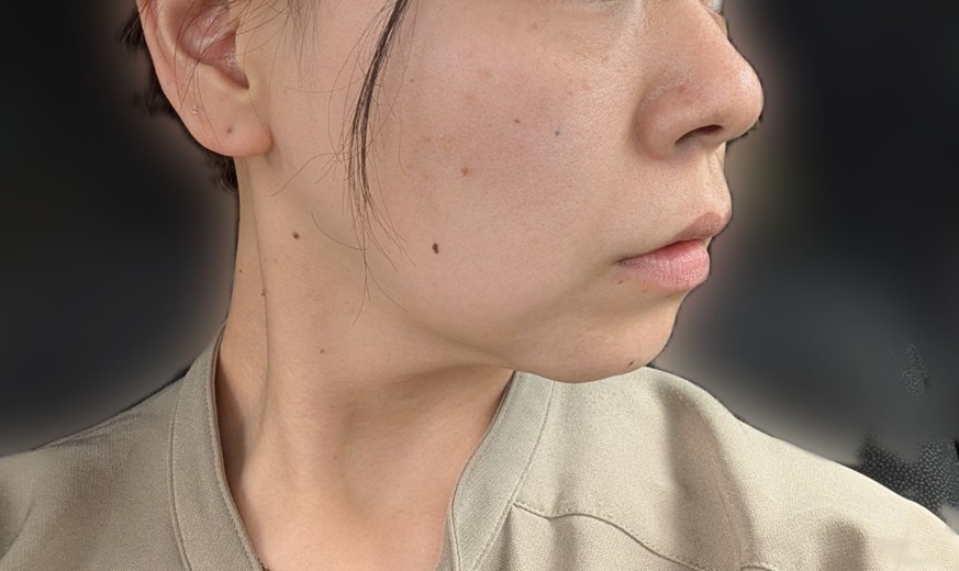 before photo: ソノクイーン(ハイフ)